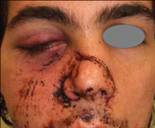 Figure 9a. A zygomatic complex and nasal bone fracture on the patient´s right side after a sporting injury